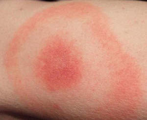 Lyme Disease Rash